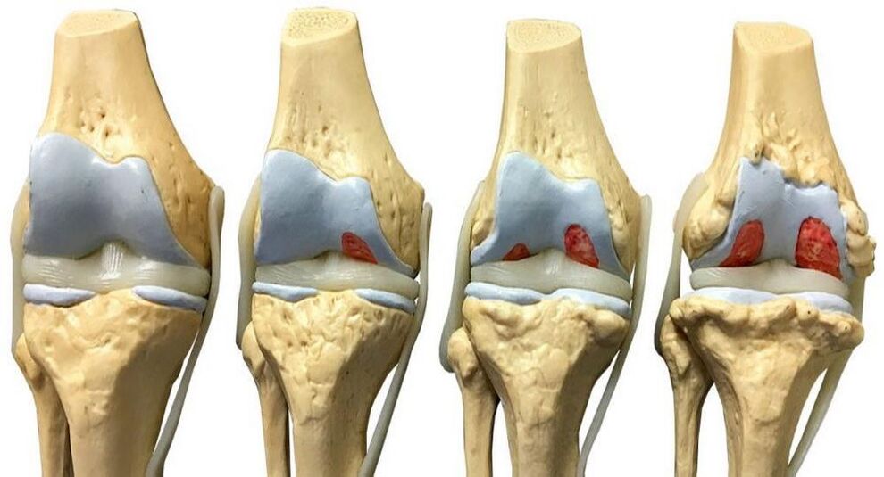 Етапи на развитие на артроза на колянната става