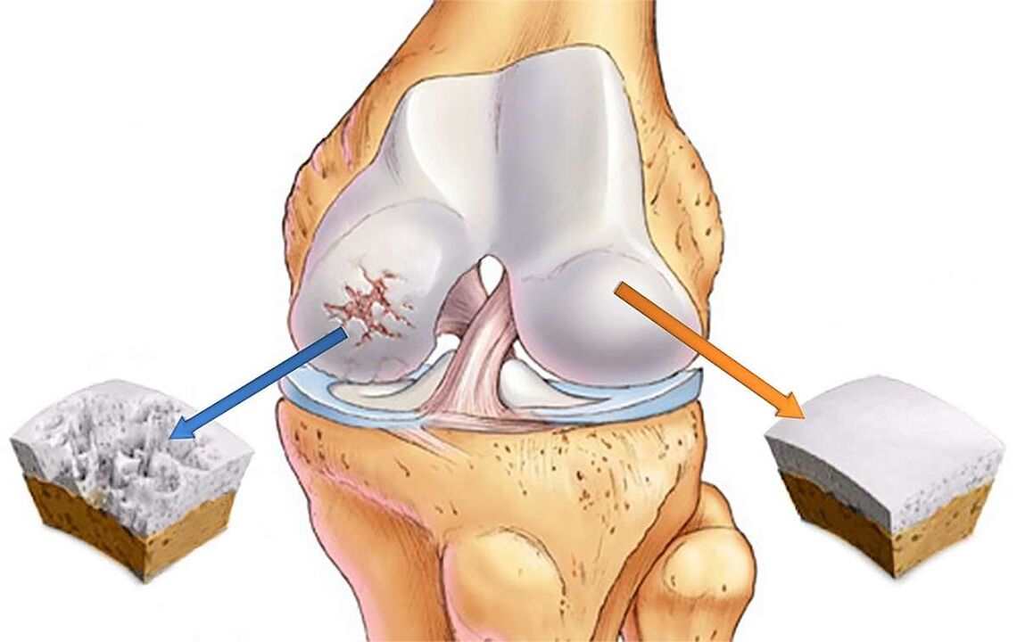 Разрушаване на хрущяла на колянната става с гонартроза