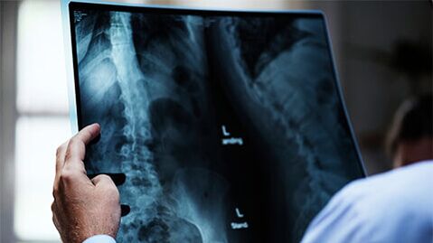 Рентгенова снимка на гръбначния стълб с остеохондроза